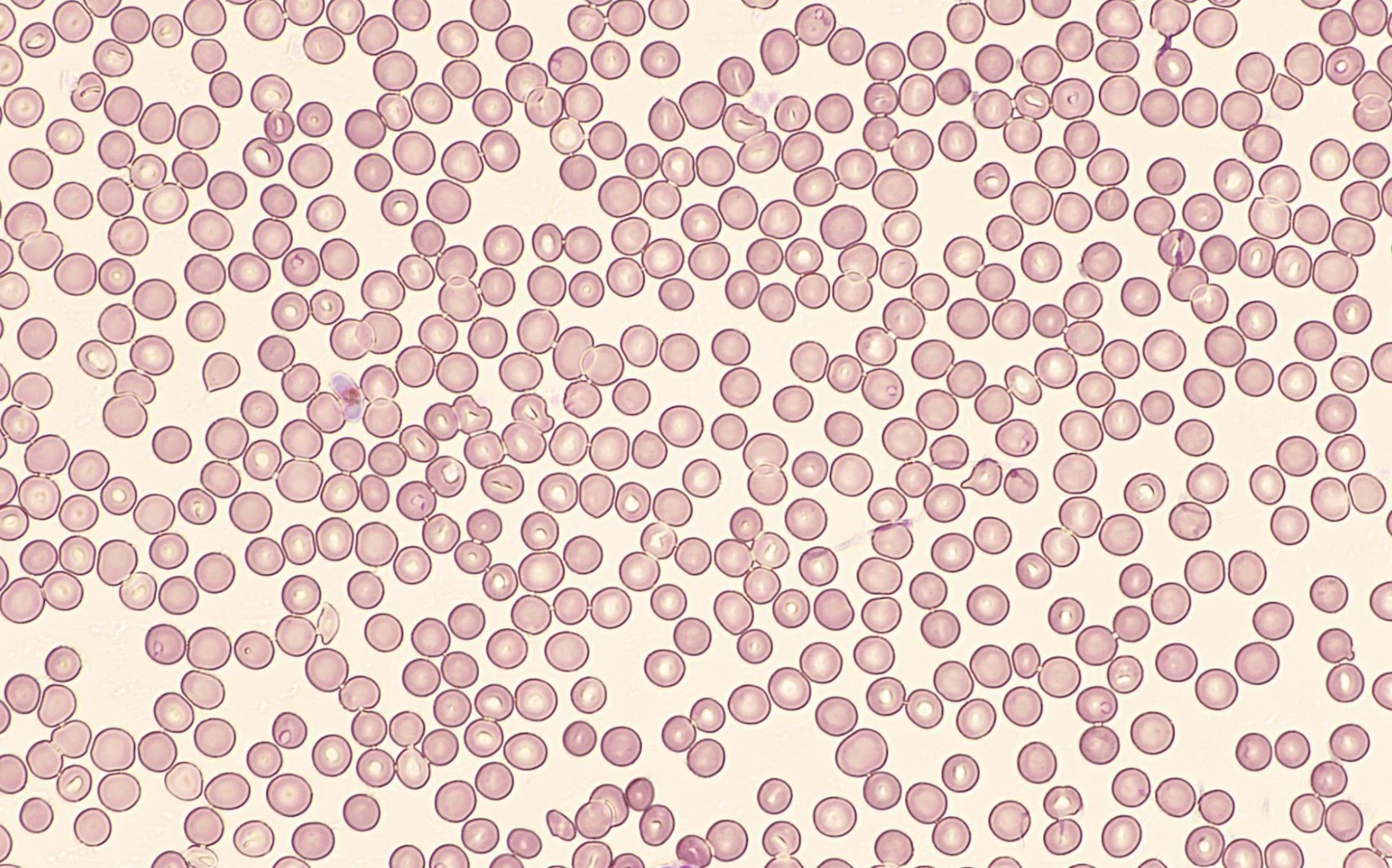 Malaria Analysis